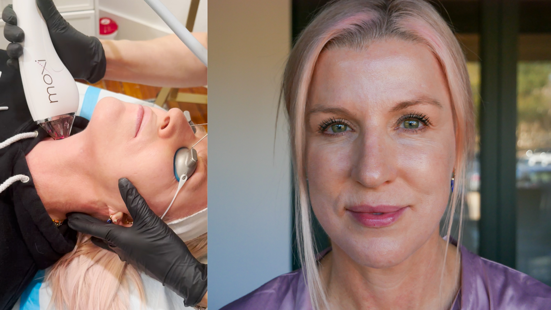 Renée Moxi Laser Treatment Experience: Before, After, & Tips